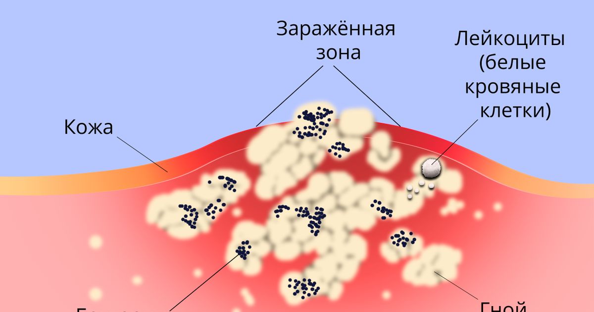 Пустула. Большая российская энциклопедия