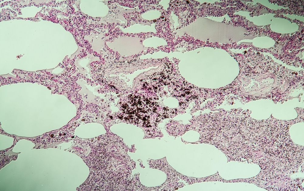 Силикоз. Большая российская энциклопедия