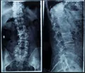 Рентгеновский снимок спины со сколиозным искривлением