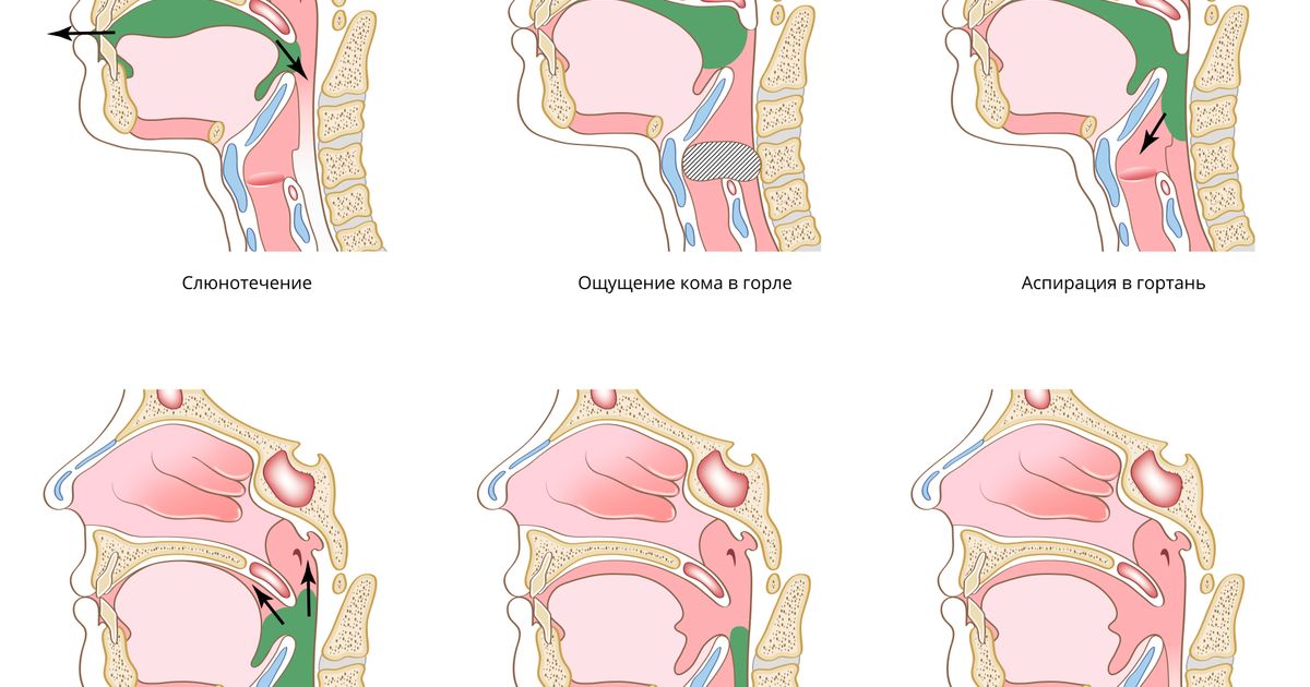 Дисфагия. Большая российская энциклопедия