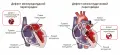 Схематическое изображение врождённых пороков сердца