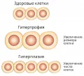 Сравнение гипертрофии и гиперплазии. Схематическое изображение