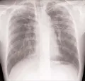 Рентгенограмма органов грудной клетки в прямой проекции. Рентгенологические признаки станноза