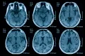 Послойное МРТ-изображение мозга человека
