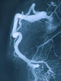 Ангиограмма правой коронарной артерии