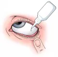 Схематическое изображение закапывания раствора в глаз
