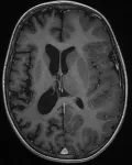 Церебральная гемиатрофия на МР-томограмме