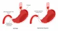Схематическое изображение привратника желудка в норме и при пилоростенозе