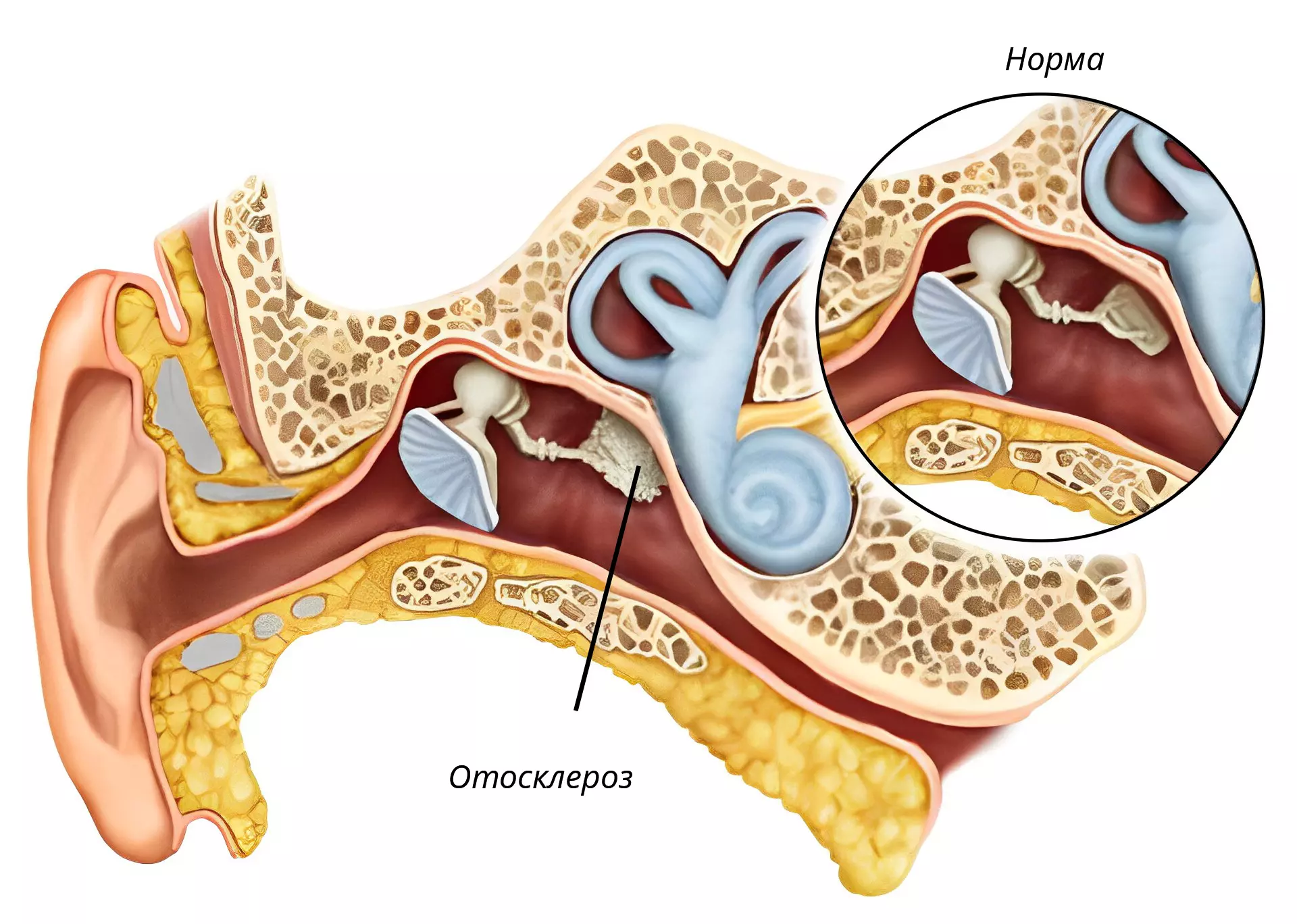 Отосклероз уха операция. Кондуктивный отосклероз. Отосклероз стапедопластика. Болезни среднего уха отосклероз.