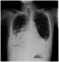Рентгенограмма грудной клетки пациента с констриктивным перикардитом