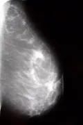 Маммографическое изображение молочной железы с мастопатией