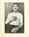 Мужчина, больной акромегалией. Фото из книги: Sajous C. Sajous's Analytical Cyclopedia of Practical Medicine. Vol. 1. Philadelphia, 1922