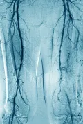 Ангиограмма артерий нижних конечностей