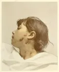 Золотуха у взрослого человека. Иллюстрация из книги: Fox G. H. Photographic Atlas of the Diseases of the Skin. Philadelphia, 1905