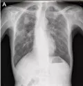 Рис. 3. Рентгенограмма органов грудной клетки в прямой проекции. Рентгенологические признаки силикоза третьей cтадии развития