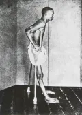 Пациент с бери-бери. 1914
