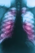 Лёгкие, поражённые саркоидозом, на рентгенограмме органов грудной клетки в прямой проекции