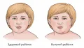 Сравнительное изображение здорового ребёнка и ребёнка, больного паротитом