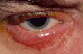 Глаз с симптомами блефарита