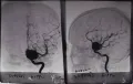 Ангиограмма, показывающая расширение кровеносного сосуда головного мозга человека
