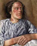 Амедео Джон Энгель Терци. Женщина, страдающая хронической пеллагрой, с дерматитом на руках, шее и лице. Ок. 1925