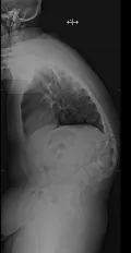 Острый тяжёлый грудопоясничный кифоз с центром в L2-L3 на боковой рентгенограмме