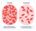Схематическое изображение крови с эритроцитами в норме и при анемии