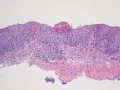 Эозинофильный эзофагит. Микрофотография