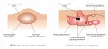 Схематическое изображение доброкачественной и злокачественной опухолей