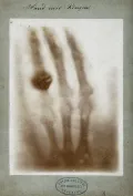 Рентгеновский снимок кисти руки с кольцом
