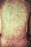 Папулёзная сыпь на спине при вторичном сифилисе