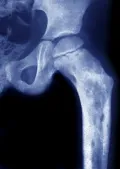Рентгеновский снимок бедренной кости с остеомиелитом