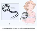 Схематическое изображение процедуры индуктотермии на плечевом суставе