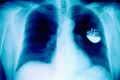 Рентгеновский снимок грудной клетки с имплантированным кардиостимулятором