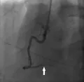 Ангиограмма коронарной артерии, на которой виден спазм сосуда при спонтанной стенокардии