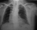 Рентгенограмма органов грудной клетки в прямой проекции 