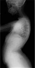 Поясничный лордоз на боковой рентгенограмме