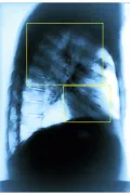 Рентгенограмма пациента, больного асбестозом