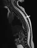 Рентгенограмма спинного мозга в боковой проекции