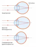 Эмметропическое и аметропическое зрение