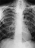 Обзорная рентгенограмма органов грудной клетки с диссеминацией