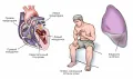 Схематическое изображение симптомов сердечной недостаточности
