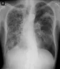 Туберкулёзная каверна в лёгких человека