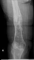 Рентгеновский снимок хронического остеомиелита с центральным секвестром