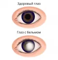 Схематическое изображение здорового глаза и глаза с бельмом
