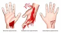 Схематическое изображение разных видов кровотечений