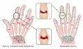 Схематическое изображение здоровой кисти и поражённой артритом 