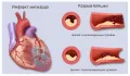 Схематическое изображение сердца и сосудов при инфаркте миокарда
