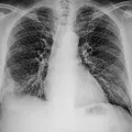 Рентгеновский снимок лёгких при пневмонии