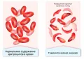 Схематическое изображение эритроцитов в норме и при гемолитической анемии
